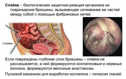 Спайки після апендициту що таке, симптоми, лікування