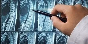 Видалення грижі хребта операційним і безопераційним способом (безопераційним) Видалення грижі хребта операційним і безопераційним способом