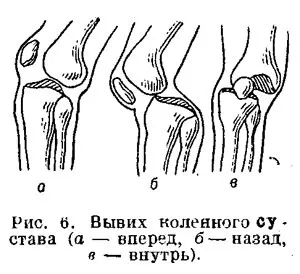 Вивих колінного суглоба симптоми, лікування, перша допомога (вивих) Вивих колінного суглоба симптоми, лікування, перша допомога