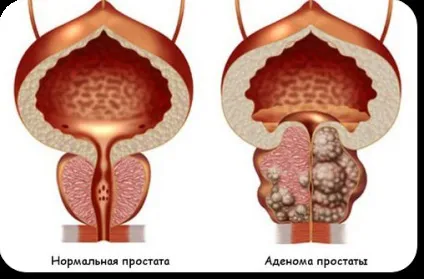 Вплив алкоголю на передміхурову залозу (передміхуровій залозі Алкоголь) Вплив алкоголю на передміхурову залозу