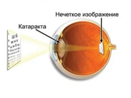 Амбліопія очі що це таке і як її лікувати (лікувати) Амбліопія очі що це таке і як її лікувати