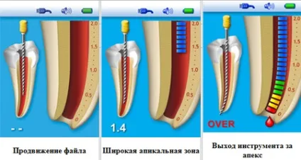 Апекслокатор в стоматології - що це за пристрій відгуки і ціни, принцип роботи, виробники (стоматології) Апекслокатор в стоматології - що це за пристрій відгуки і ціни, принцип роботи, виробники