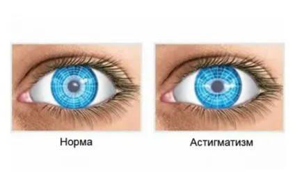 Астигматизм класифікація, діагностика і лікування (лікування) Астигматизм класифікація, діагностика і лікування