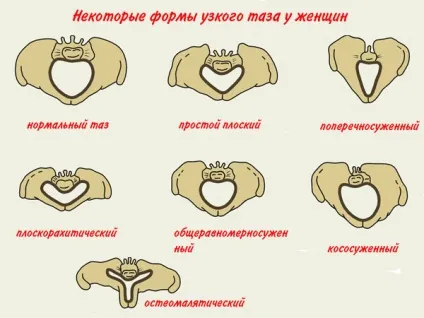 Анатомічно і клінічно вузький таз - як визначають розміри в акушерстві, невідкладна допомога, 1-2 (визначають) Анатомічно і клінічно вузький таз - як визначають розміри в акушерстві, невідкладна допомога, 1-2