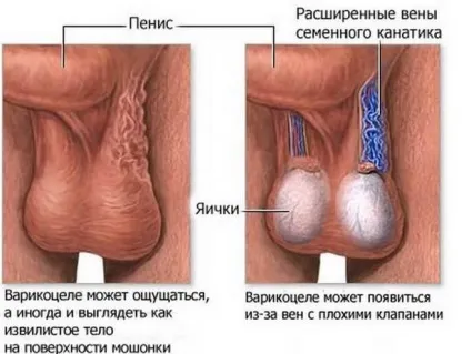Азооспермія (у спермі немає сперматозоїдів) що це, лікування (відгуки чоловіків), чи можна вилікуватися