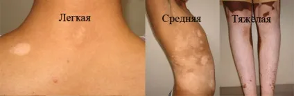 Білі плями на шкірі після засмаги фото, що це і як лікувати, кращі народні рецепти (лікування) Білі плями на шкірі після засмаги фото, що це і як лікувати, кращі народні рецепти