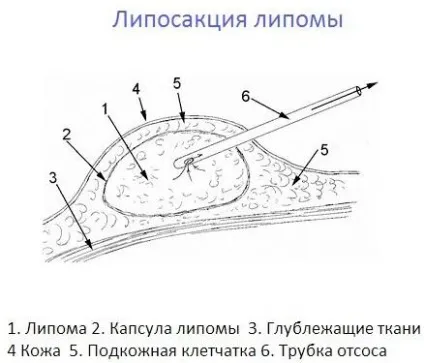 Білі жировики на обличчі як позбутися, видалити, причини (білі жировики особі) Білі жировики на обличчі як позбутися, видалити, причини