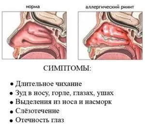 Болить ніс від нежиті що робити (нежиті) Болить ніс від нежиті що робити