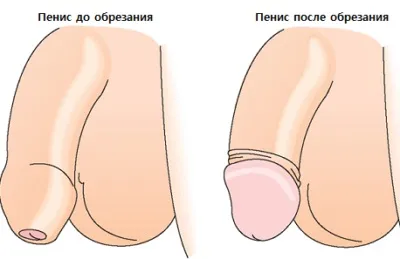 Боляче робити обрізання дорослому чи ні і на скільки це неприємно в 18 років, а так само через (скільки) Боляче робити обрізання дорослому чи ні і на скільки це неприємно в 18 років, а так само через