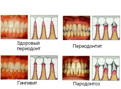 Болить зуб і болить ясна що робити в домашніх умовах (ясна) Болить зуб і болить ясна що робити в домашніх умовах