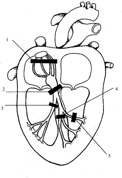 блокада серця
