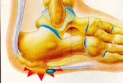Біль у стопі (у верхній частині і суглобах) чому болить і лікування (суглобах) Біль у стопі (у верхній частині і суглобах) чому болить і лікування
