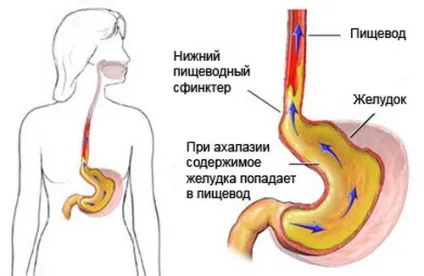 Біль в стравоході при ковтанні причини виникнення (стравоході) Біль в стравоході при ковтанні причини виникнення