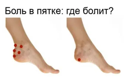 Біль у п'яті увагу до симптомів та лікування (ноги) Біль у п'яті увагу до симптомів та лікування