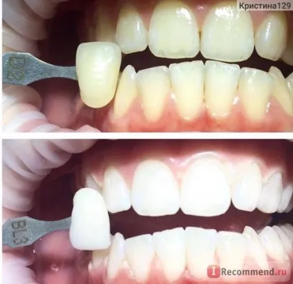 Brilliant smile косметичне відбілювання зубів - «болю не було зовсім! », Відгуки покупців (smile) Brilliant smile косметичне відбілювання зубів - «болю не було зовсім!