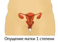 Чим небезпечне опущення матки у жінок (матки) Чим небезпечне опущення матки у жінок