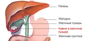 Чим небезпечні камені в жовчному міхурі, нанотехнології для здоров'я, відновлення без ліків (камені в жовчному міхурі симптоми) Чим небезпечні камені в жовчному міхурі, нанотехнології для здоров'я, відновлення без ліків