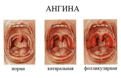 Чим відрізняється тонзиліт від ангіни як відрізнити, різниця, фото, гострий, хронічний (тонзиліт) Чим відрізняється тонзиліт від ангіни як відрізнити, різниця, фото, гострий, хронічний