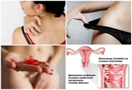 Свербить (свербіж) в паху у жінок причини, симптоми, лікування (свербіж) Свербить (свербіж) в паху у жінок причини, симптоми, лікування