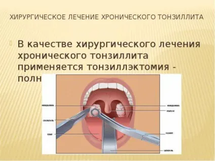 Чим відрізняється тонзиліт від ангіни як відрізнити, різниця, фото, гострий, хронічний (гострий) Чим відрізняється тонзиліт від ангіни як відрізнити, різниця, фото, гострий, хронічний