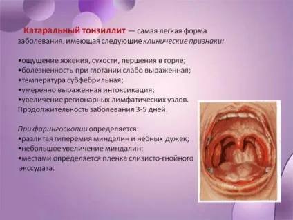 Чим відрізняється тонзиліт від ангіни як відрізнити, різниця, фото, гострий, хронічний (гострий) Чим відрізняється тонзиліт від ангіни як відрізнити, різниця, фото, гострий, хронічний