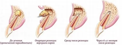 Що робити, якщо болить корінь зуба симптоми запалення та інших проблем (запалення кореня зуба лікування) Що робити, якщо болить корінь зуба симптоми запалення та інших проблем