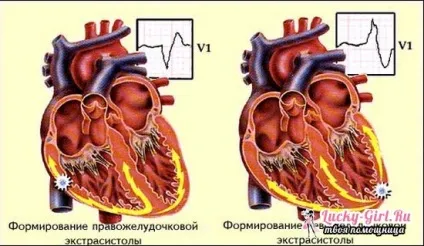 Що таке екстрасистоли і як від них позбавитися (екстрасистоли) Що таке екстрасистоли і як від них позбавитися