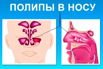 Що таке вірусний риніт і як лікувати нежить від вірусів (риніт) Що таке вірусний риніт і як лікувати нежить від вірусів