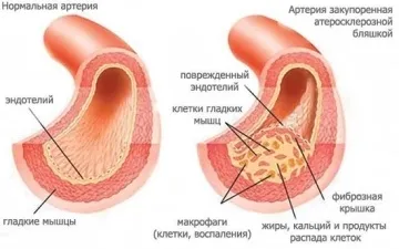 Що таке кардіосклероз і як лікується це захворювання