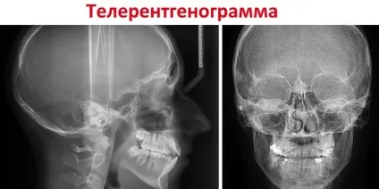 Що таке телерентгенографія (трг) і що дозволяє виявити телерентгенограмм (телерентгенограмм) Що таке телерентгенографія (трг) і що дозволяє виявити телерентгенограмм