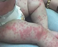 Вузликовий періартеріїт що це таке, симптоми та лікування у дітей та дорослих лікування