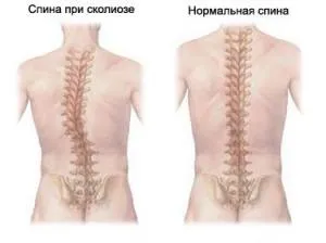 Cколіоз - причини, симптоми і народні засоби лікування cколіоза (причини) Cколіоз - причини, симптоми і народні засоби лікування cколіоза
