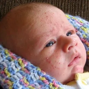 Цвітіння новонароджених причини акне, як відрізнити від алергії, лікування (алергії) Цвітіння новонароджених причини акне, як відрізнити від алергії, лікування