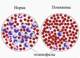 Цистицеркоз (цистицерки) у людини, симптоми