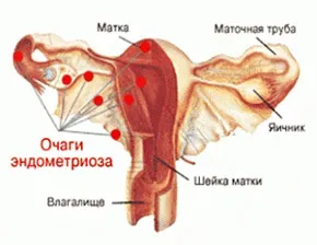 Дифузний ендометріоз тіла матки (матки) Дифузний ендометріоз тіла матки