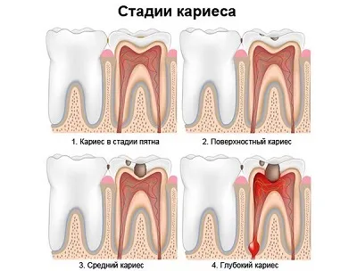 Дитячий карієс зубів причини появи у немовлят, однорічного і дворічної дитини, стадії (карієс у однорічної дитини) Дитячий карієс зубів причини появи у немовлят, однорічного і дворічної дитини, стадії