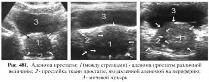 Діагностика захворювань простати (діагностика захворювань простати) Діагностика захворювань простати