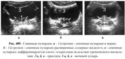 Діагностика захворювань простати (простати) Діагностика захворювань простати