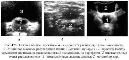 Діагностика захворювань простати (більш високої ехогенності) Діагностика захворювань простати