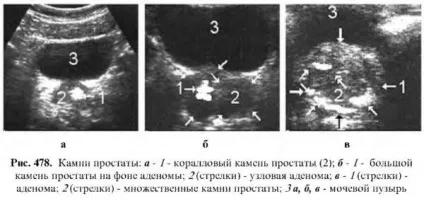 Діагностика захворювань простати (простати) Діагностика захворювань простати
