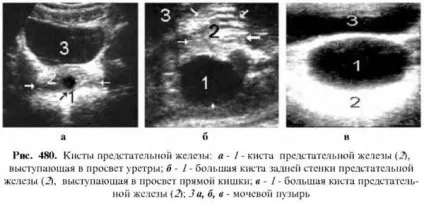 Діагностика захворювань простати (діагностика) Діагностика захворювань простати