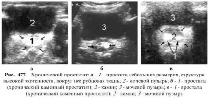 Діагностика захворювань простати (захворювань) Діагностика захворювань простати