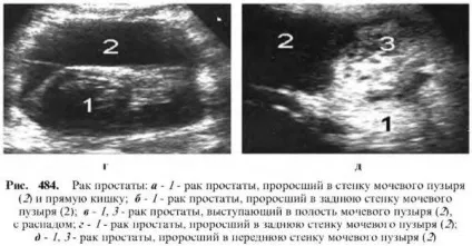 Діагностика захворювань простати (діагностика) Діагностика захворювань простати