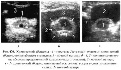 Діагностика захворювань простати (захворювань) Діагностика захворювань простати