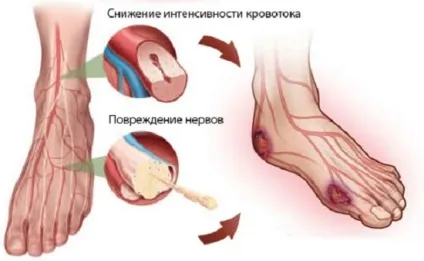 Діабетична стопа види, причини, симптоми, лікування (діабетична) Діабетична стопа види, причини, симптоми, лікування