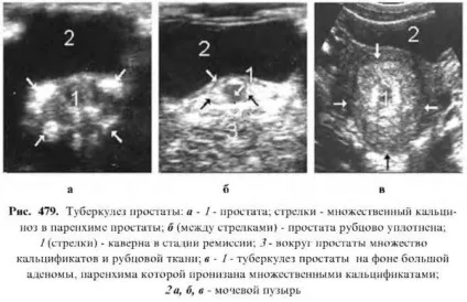 Діагностика захворювань простати (діагностика захворювань простати) Діагностика захворювань простати