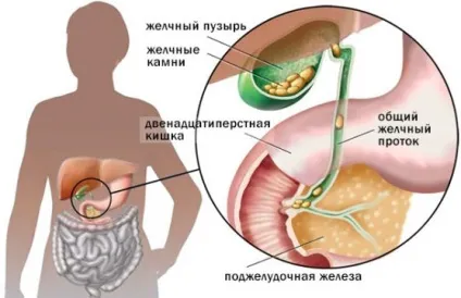 Дієта при панкреатиті, гастриті і холециститі (холециститі) Дієта при панкреатиті, гастриті і холециститі