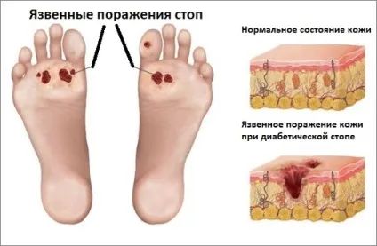 Діабетична стопа види, причини, симптоми, лікування (лікування) Діабетична стопа види, причини, симптоми, лікування