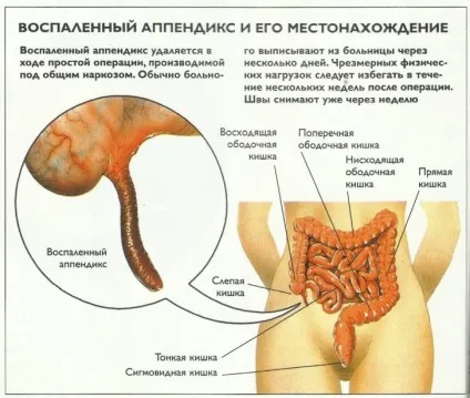 Дієта після видалення апендициту харчування, меню після апендициту, продукти (меню) Дієта після видалення апендициту харчування, меню після апендициту, продукти