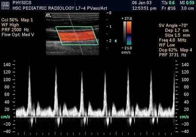 Доплерографія плода що це (УЗДГ плода) (плода) Доплерографія плода що це (УЗДГ плода)